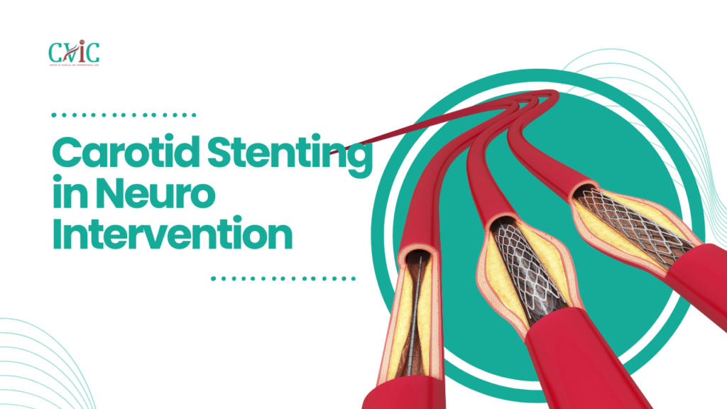 Carotid Stenting in Neuro Intervention