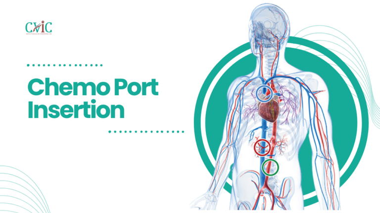 Chemotherapy port insertion