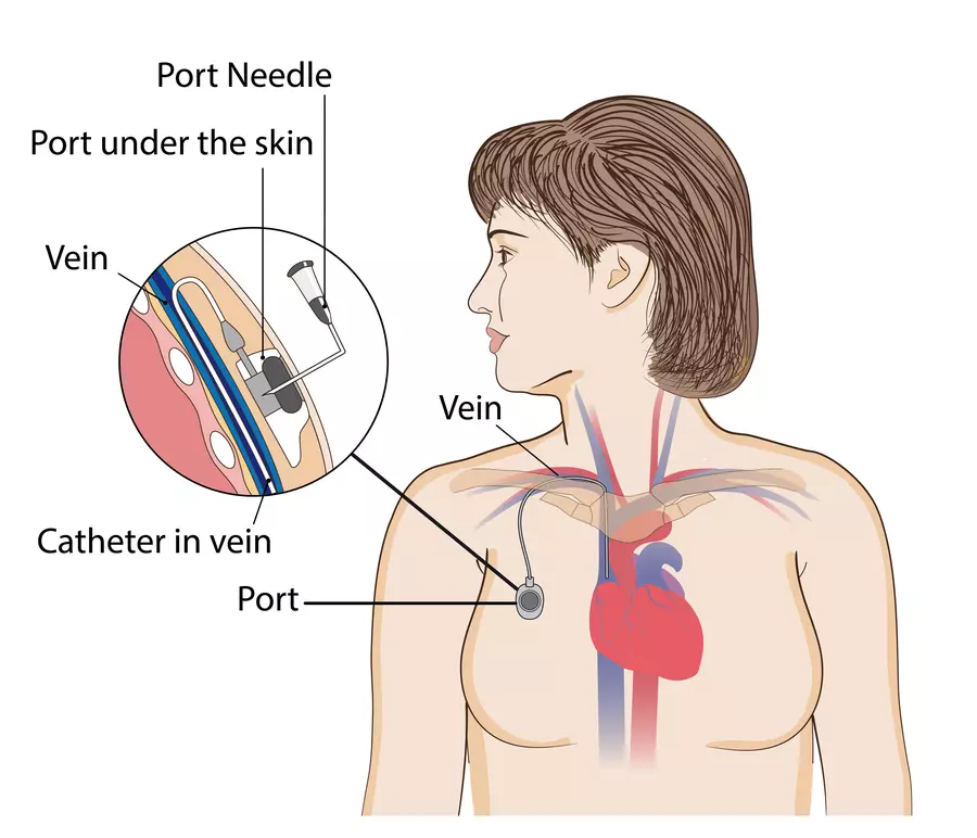 Chemotherapy Port Insertion