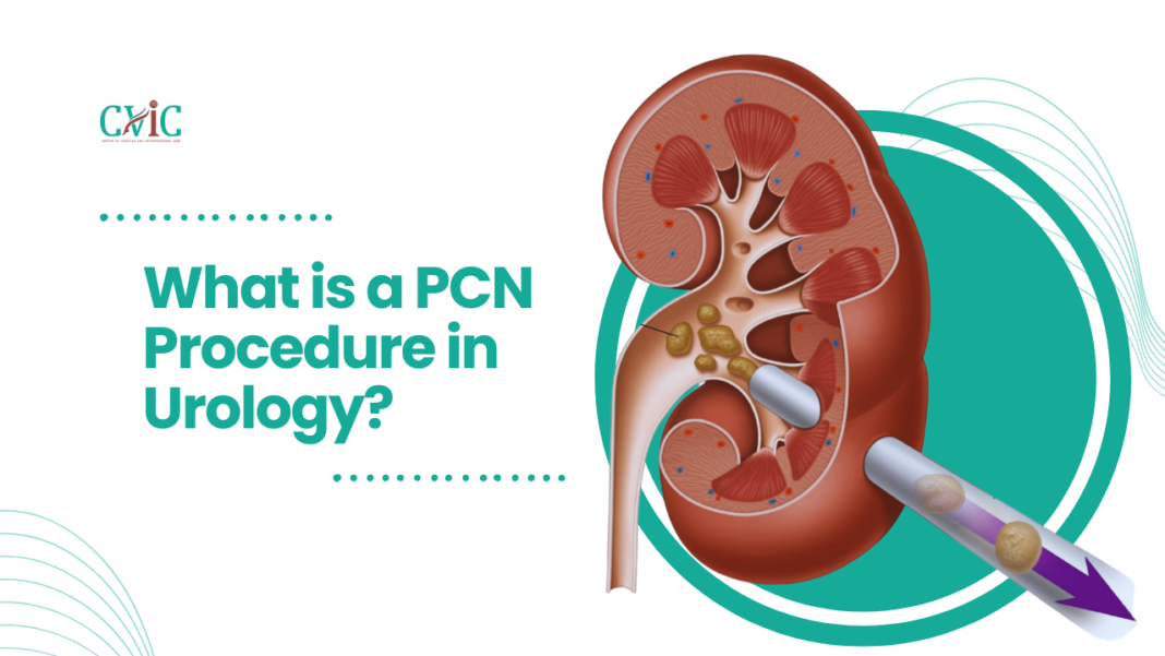 what-is-a-pcn-procedure-in-urology