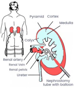 Pcn Injection Muscle What is a PCN Procedure in Urology?