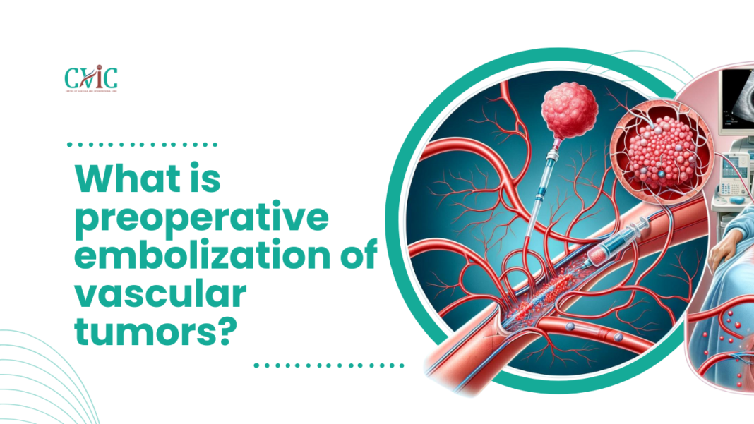What is preoperative embolization of vascular tumors?