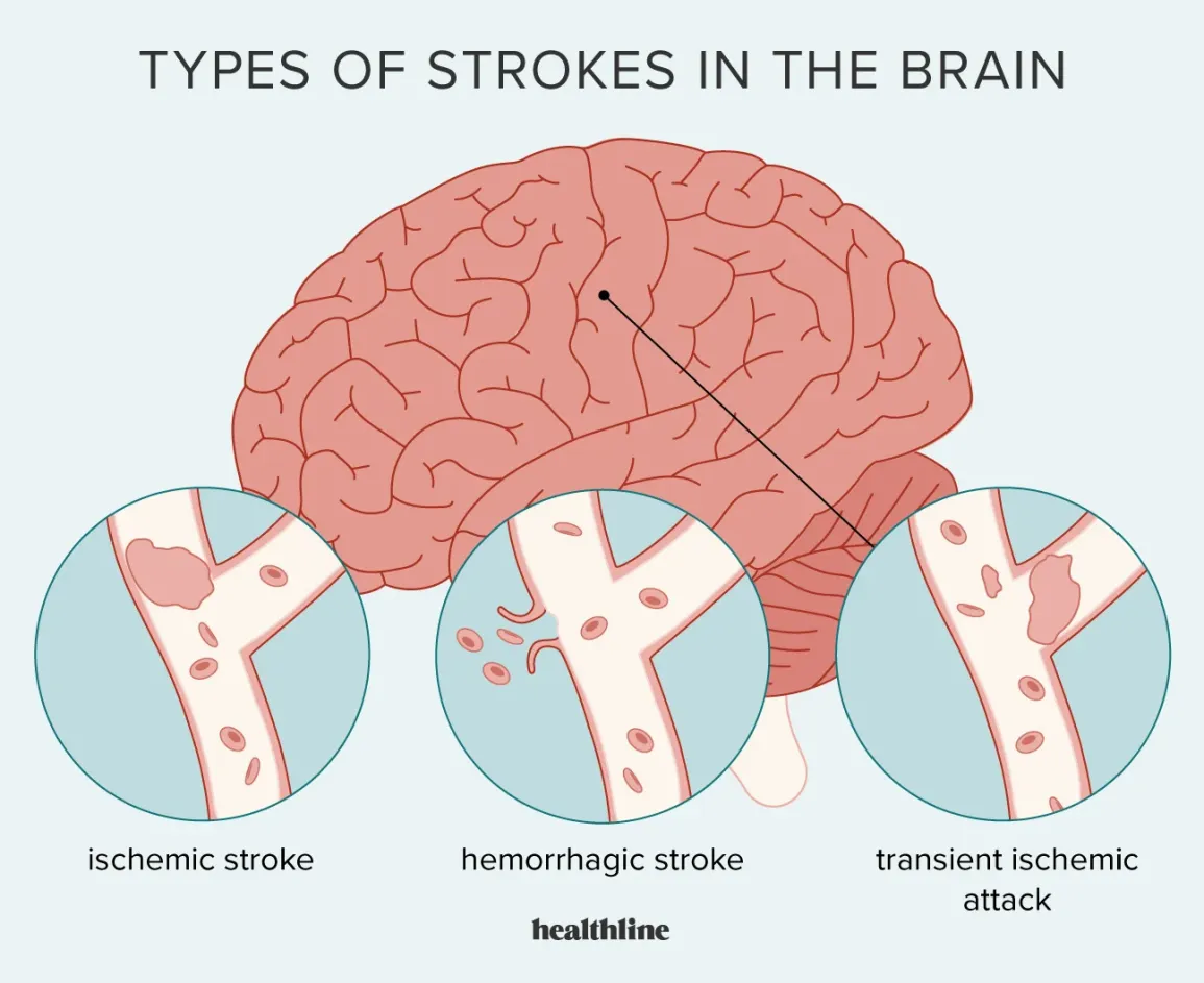 Brain Stroke: Early Warning Signs and Prevention Tips
