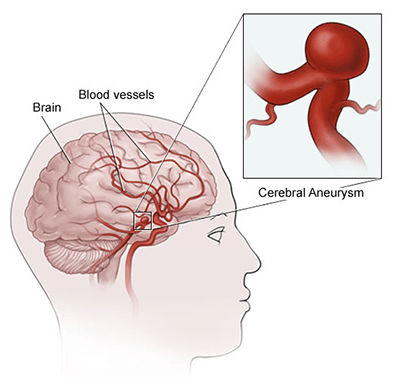 Best treatment for an aneurysm by expert doctors in Indore