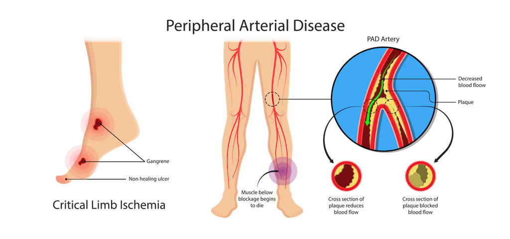 PAD Symptoms in Legs