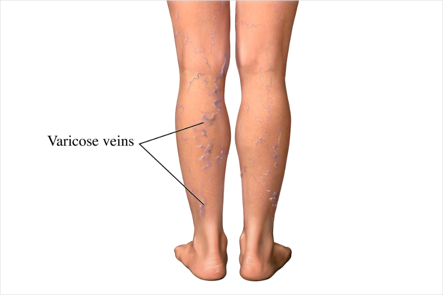 The newest treatment for varicose veins providing pain-free, minimally invasive options.