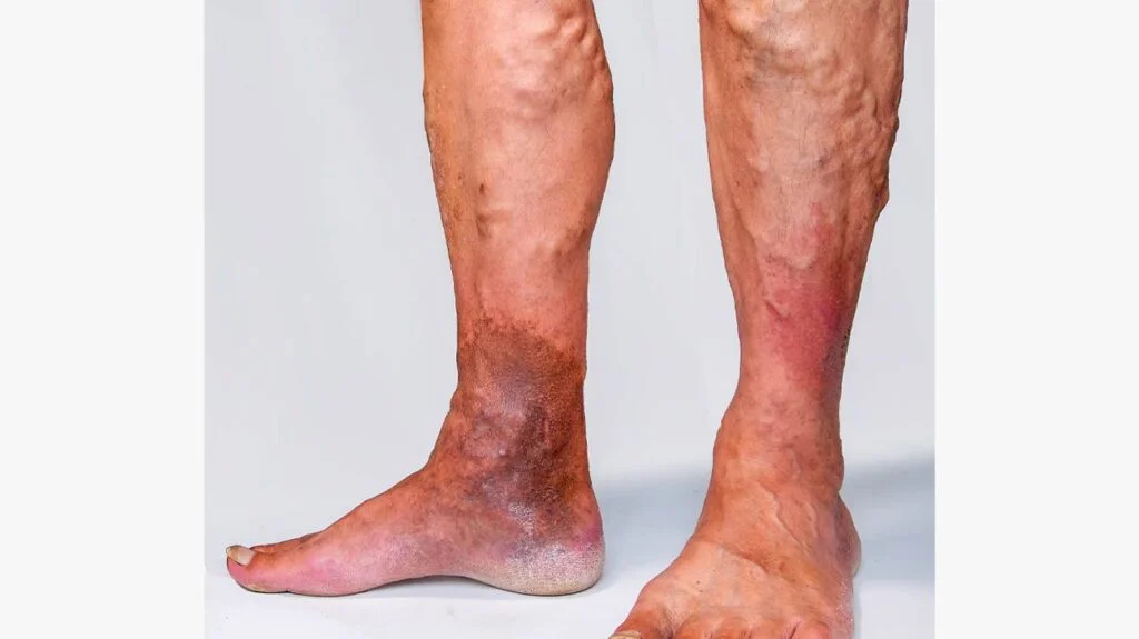 Newest Treatment for Varicose Veins
