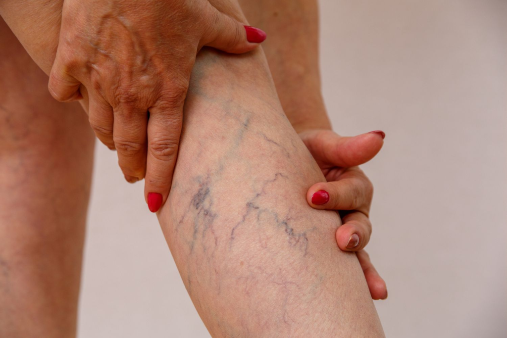 Most effective treatment for varicose veins illustrated in a medical setting.