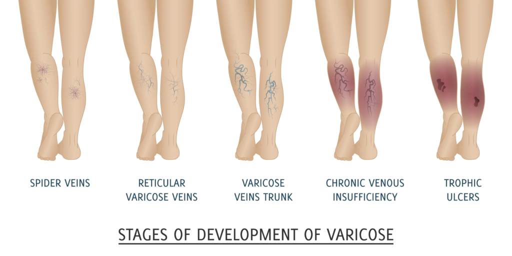 Most Effective Treatment for Varicose Veins
