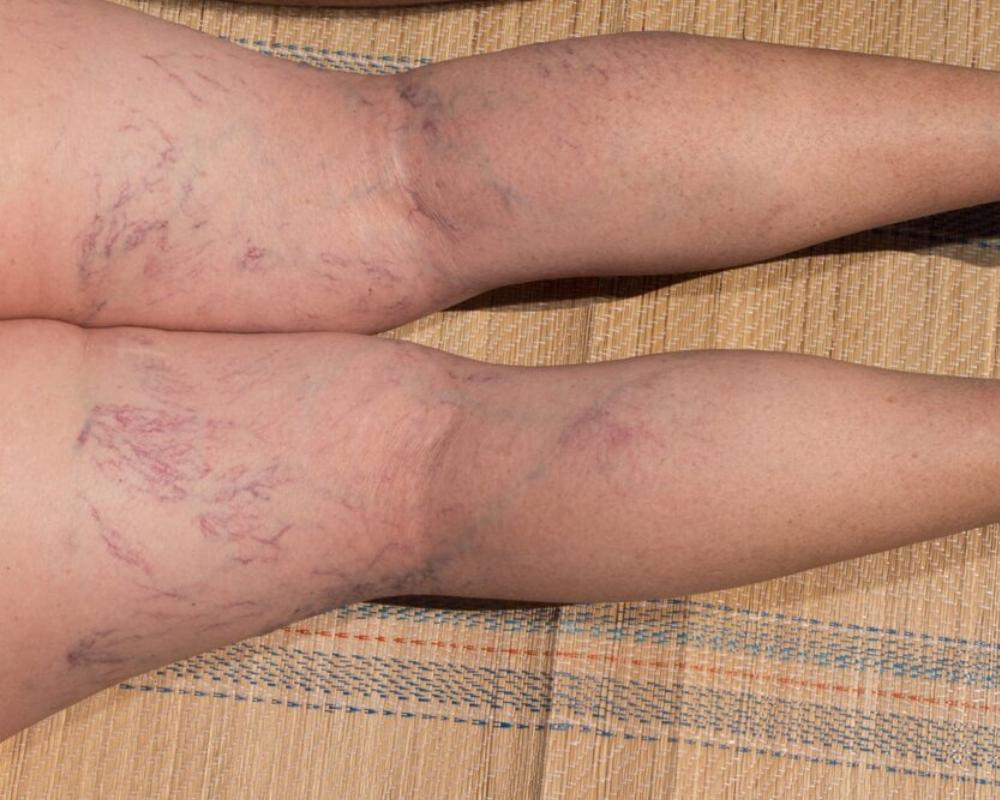 Best treatment for varicose veins with medical procedures and lifestyle tips.