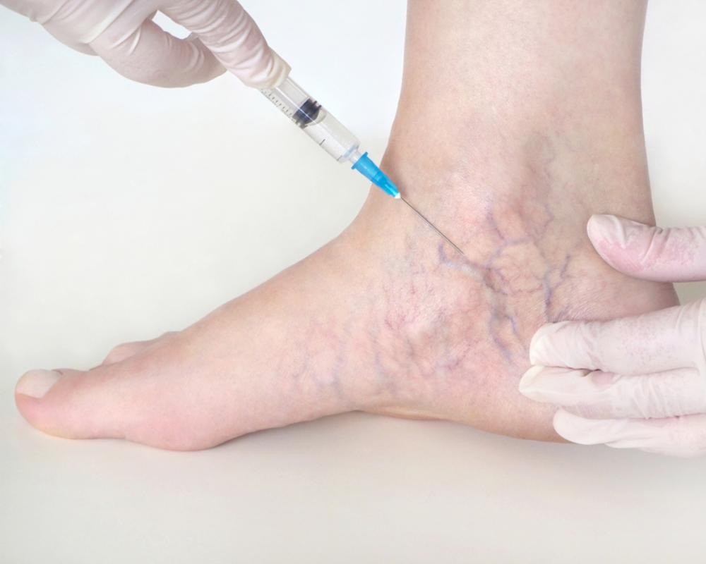 Best Treatment for Varicose Veins