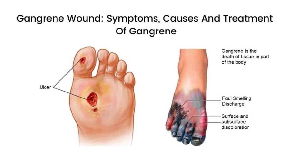 Gangrene treatment at CVIC