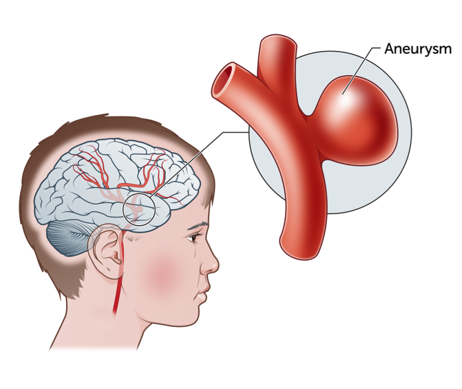 Brain Aneurysm doctor in Indore treating a patient at CVIC.