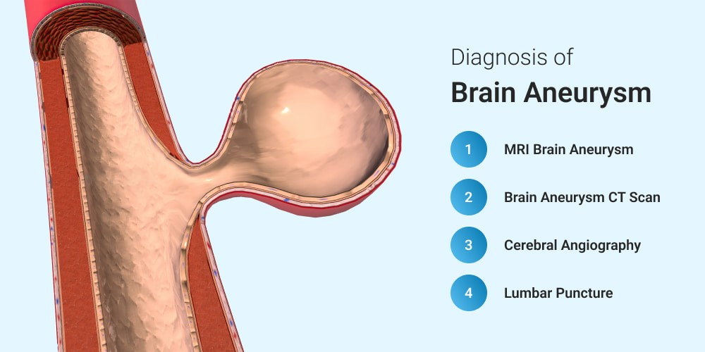 Brain Aneurysm Doctor in Indore
