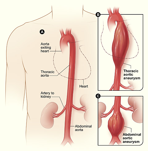 Aortic Aneurysm - Expert Care by Brain Aneurysm Doctors in Indore