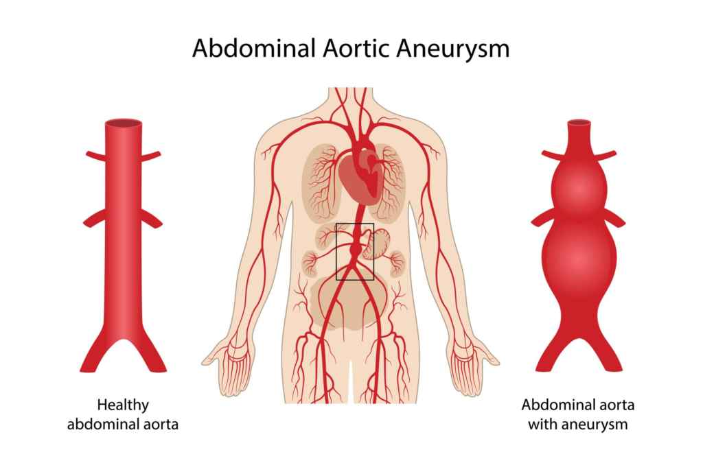 Aortic Aneurysm