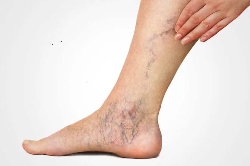 Newest Treatments for Varicose Veins