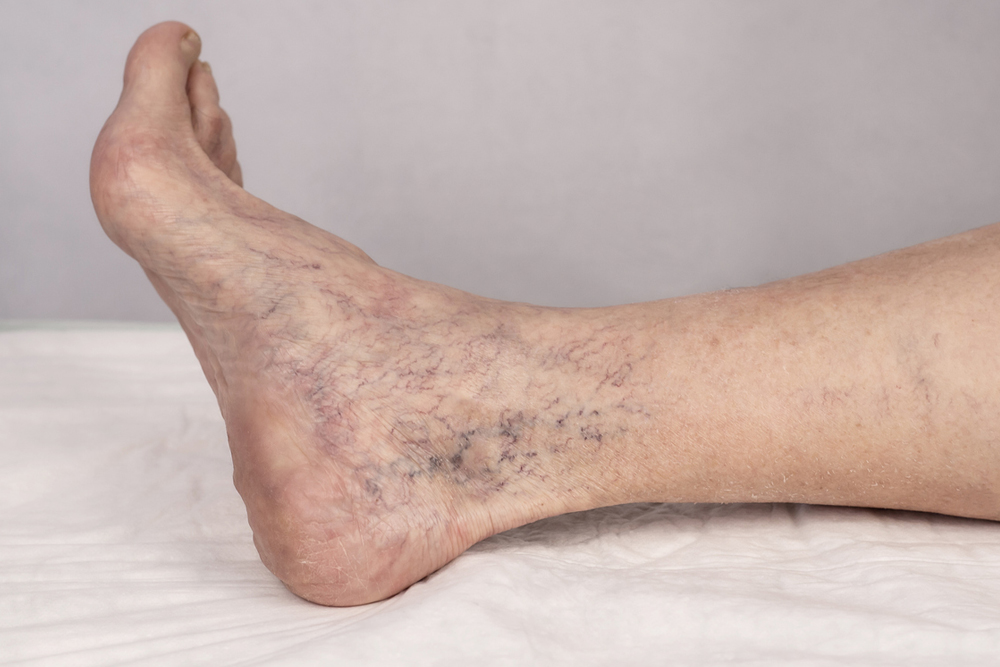 Newest Treatments for Varicose Veins