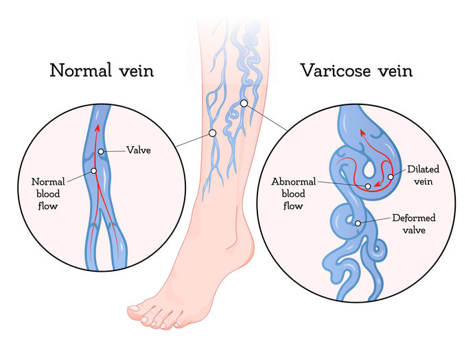 Illustration of varicose veins with effective treatment methods