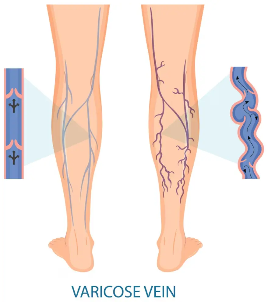 Illustration of varicose veins with effective treatment methods