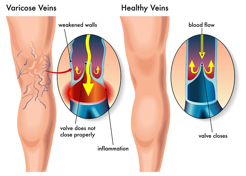 Illustration of varicose veins with effective treatment methods