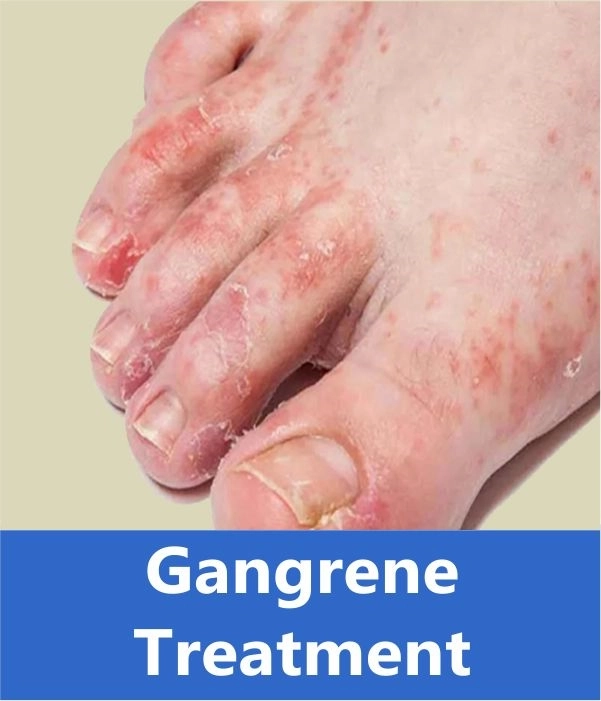 Can Gangrene Recur After Treatment