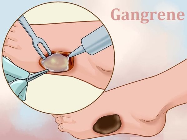 Can Gangrene Recur After Treatment