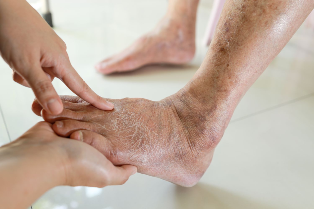 Tips for Managing Diabetic Foot