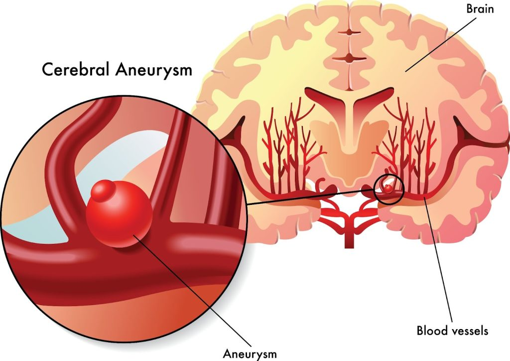 Top Brain Aneurysm Doctors in Indore