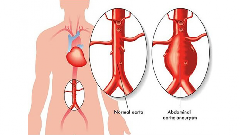 Aortic Aneurysm