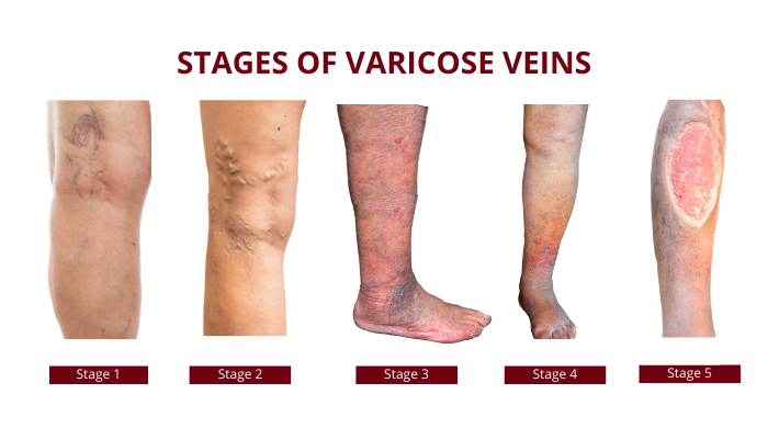 Visible varicose veins on legs showing swelling and discoloration