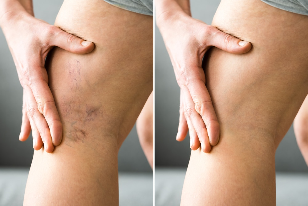 A detailed infographic showing various treatments for varicose veins