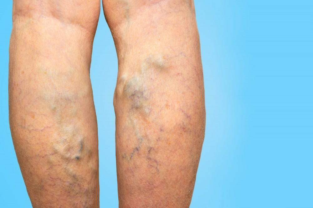 Newest Treatment for Varicose Veins: Innovations in Vascular Health