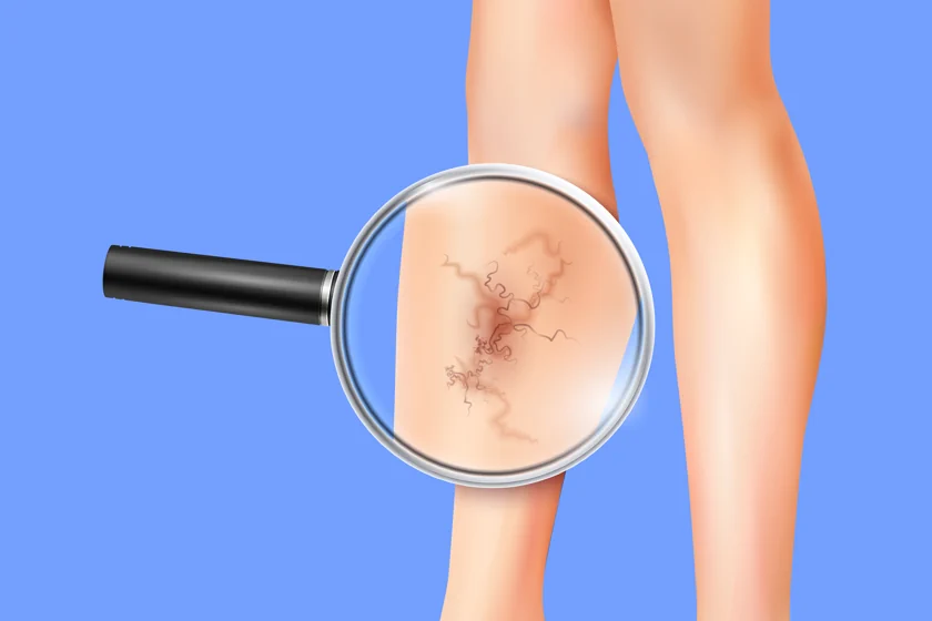 Newest Treatment for Varicose Veins: Innovations in Vascular Health