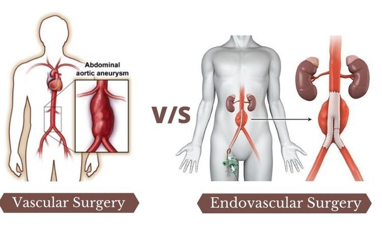 What conditions does an endovascular surgeon treat