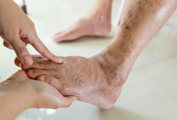 How to prevent diabetic foot problems with proper care and management.