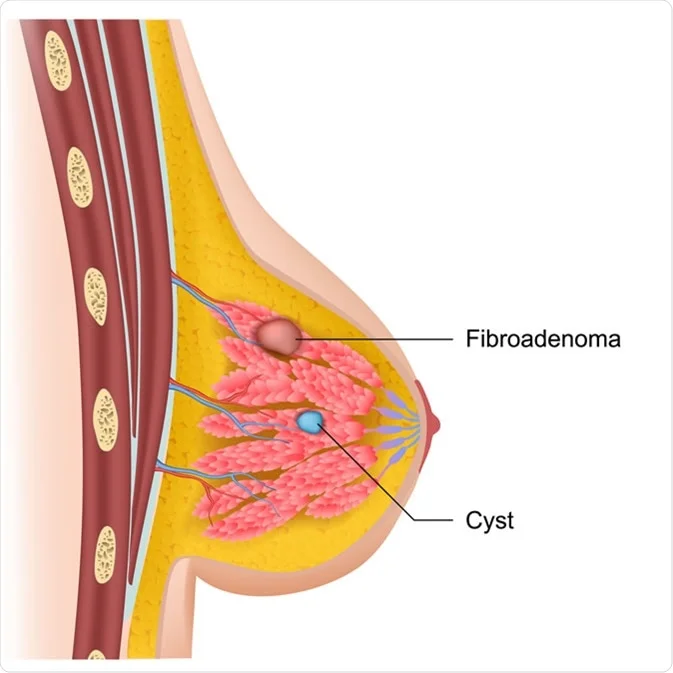 Breast Fibroadenoma