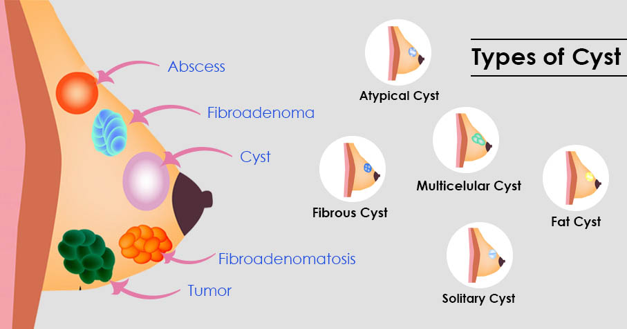 Breast Fibroadenoma