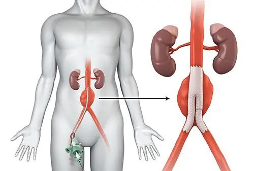 Endovascular Surgery