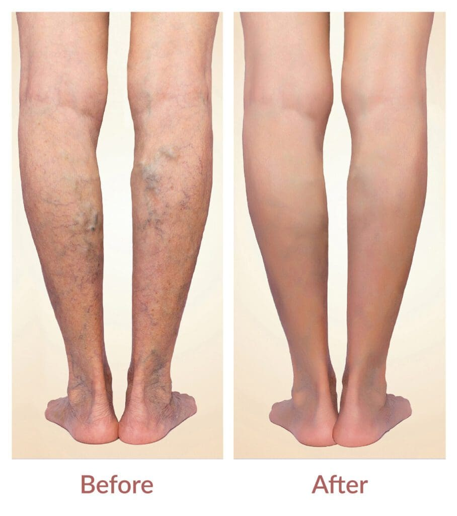 Varicose Veins