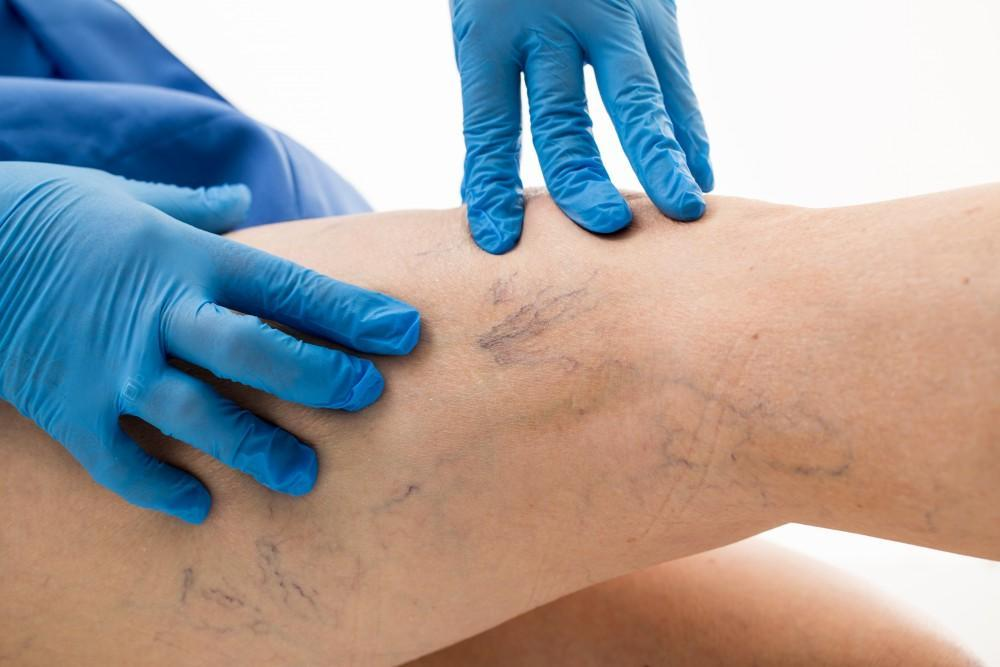 Varicose Veins
