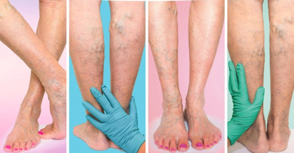 Varicose Veins