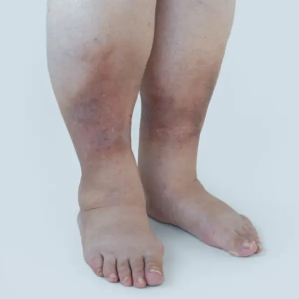 Gangrene
