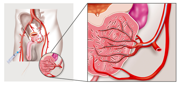 Prostatic Artery Embolization