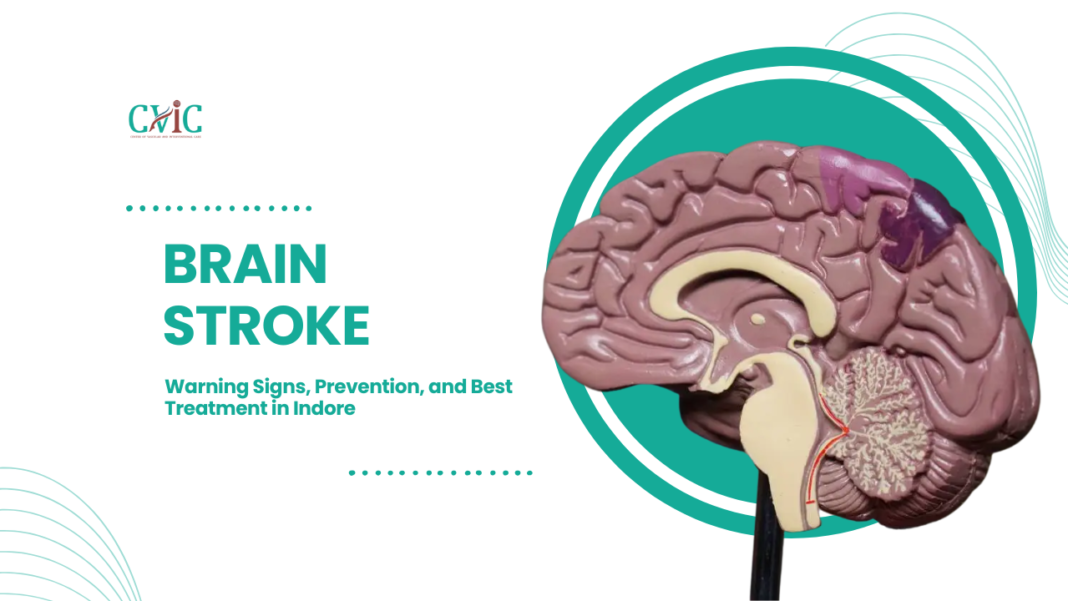 Brain Stroke: Warning Signs, Prevention, and Best Treatment