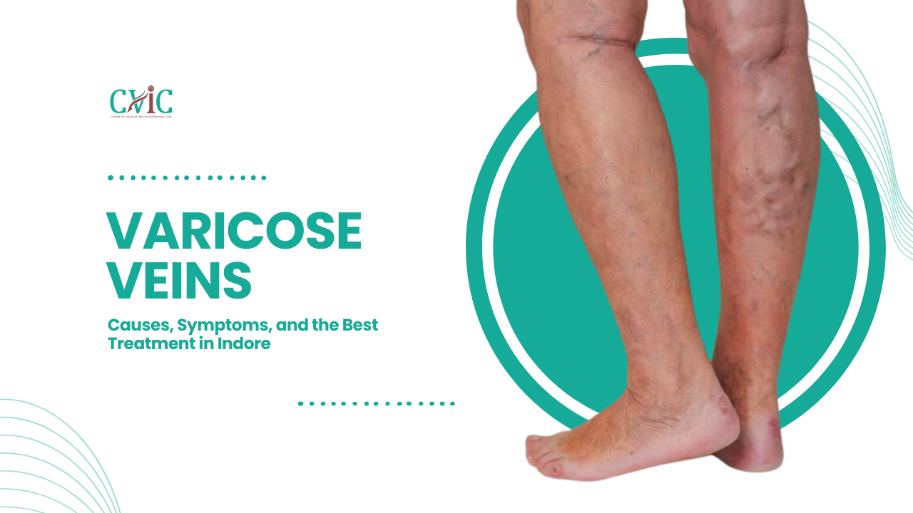 Varicose Veins: Causes, Symptoms, and the Best Treatment in Indore