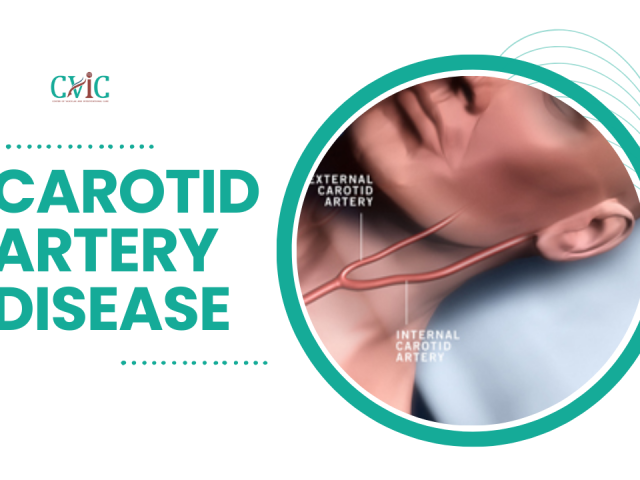 Carotid Artery Disease: Preventing Stroke with Stenting and Angioplasty