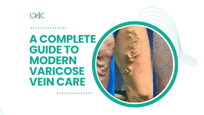 A Complete Guide to Modern Varicose Vein Care