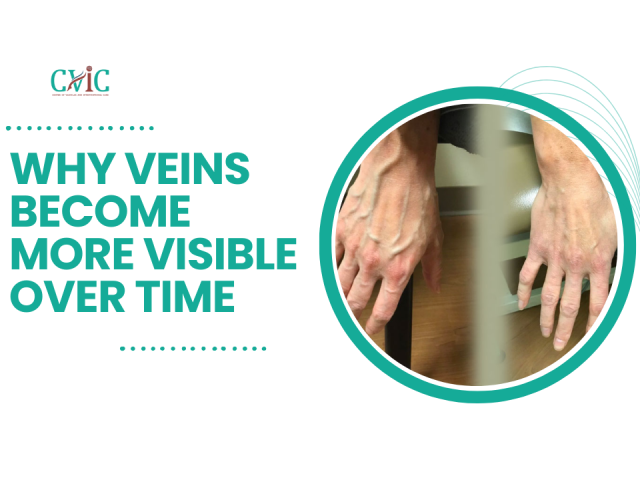 Hand Veins and Aging: Why Veins Become More Visible Over Time
