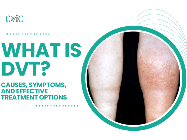 What is DVT? Causes, Symptoms, and Effective Treatment Options